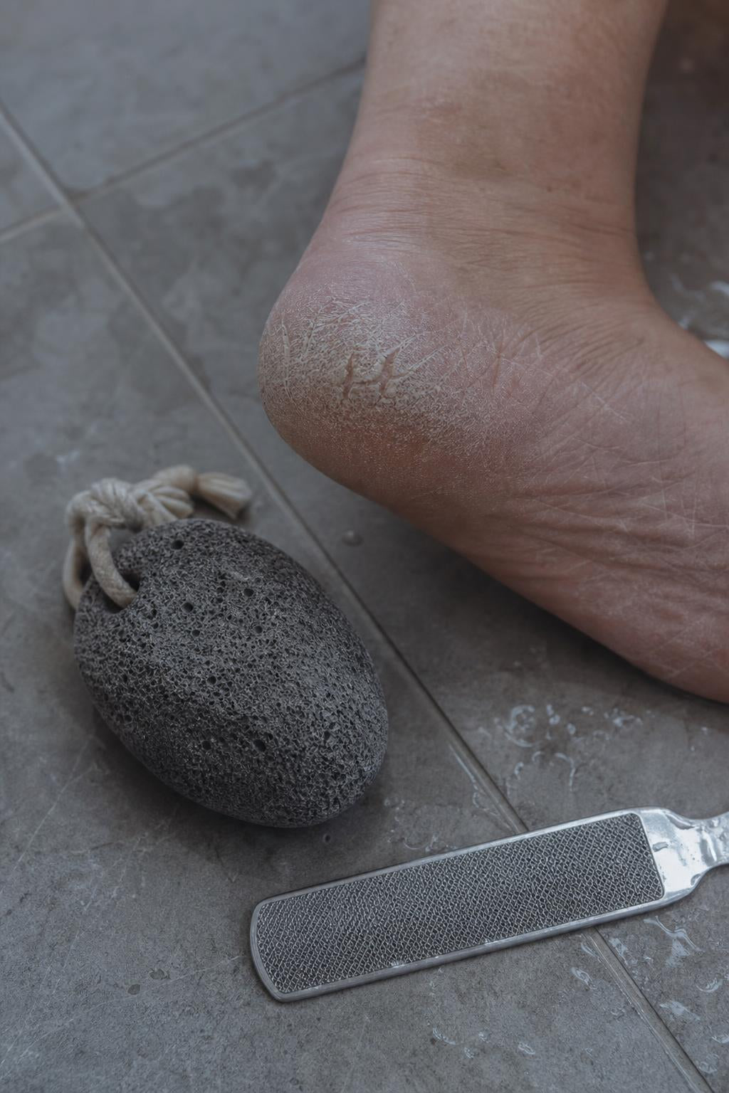 Talón con durezas junto a una piedra pómez